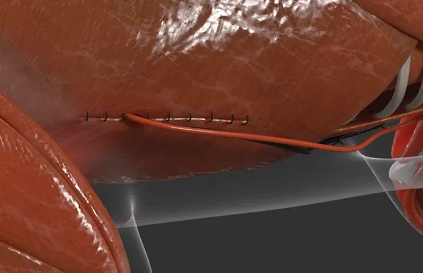 Video Category - Kaha Surgical Videos